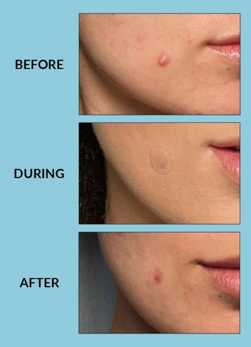 TALIKA PARIS PIMPLE FREE PATCHES 25PCS
